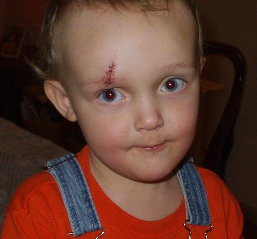 Elijah fell at the Dr.'s office after Mary's Dr. appointment. He got 7 stitches and 3 suckers.