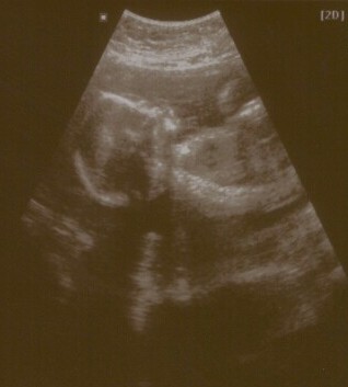 Looks like Elijah and Abigail's ultrasound picture!